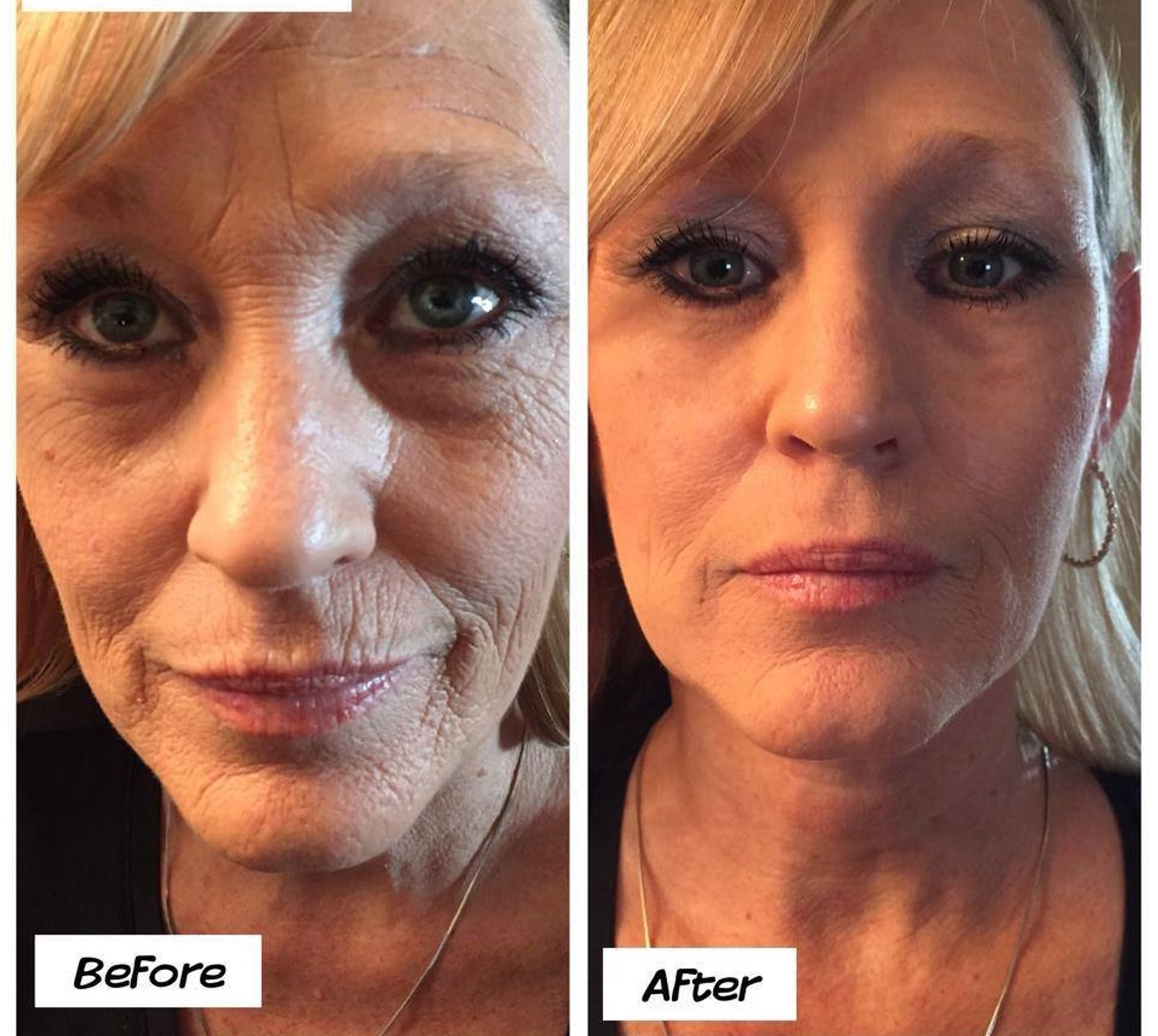 instant-youth-before-after-1 instant-youth-before-after-1